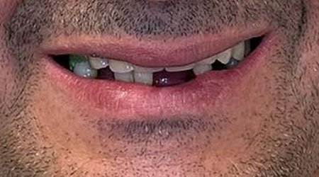 Caso antes implantes dentales 01