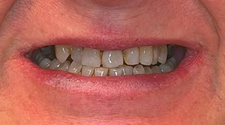 Caso antes implantes dentales 02