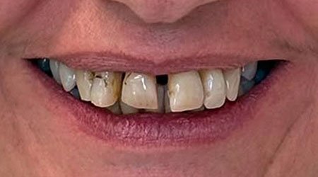 Caso antes implantes dentales 03