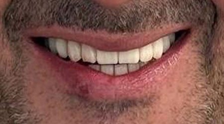 Caso después implantes dentales 01