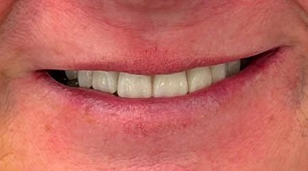 Caso después implantes dentales 02