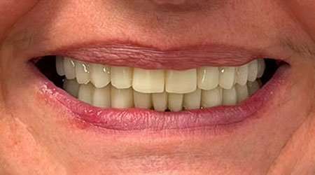 Caso después implantes dentales 03