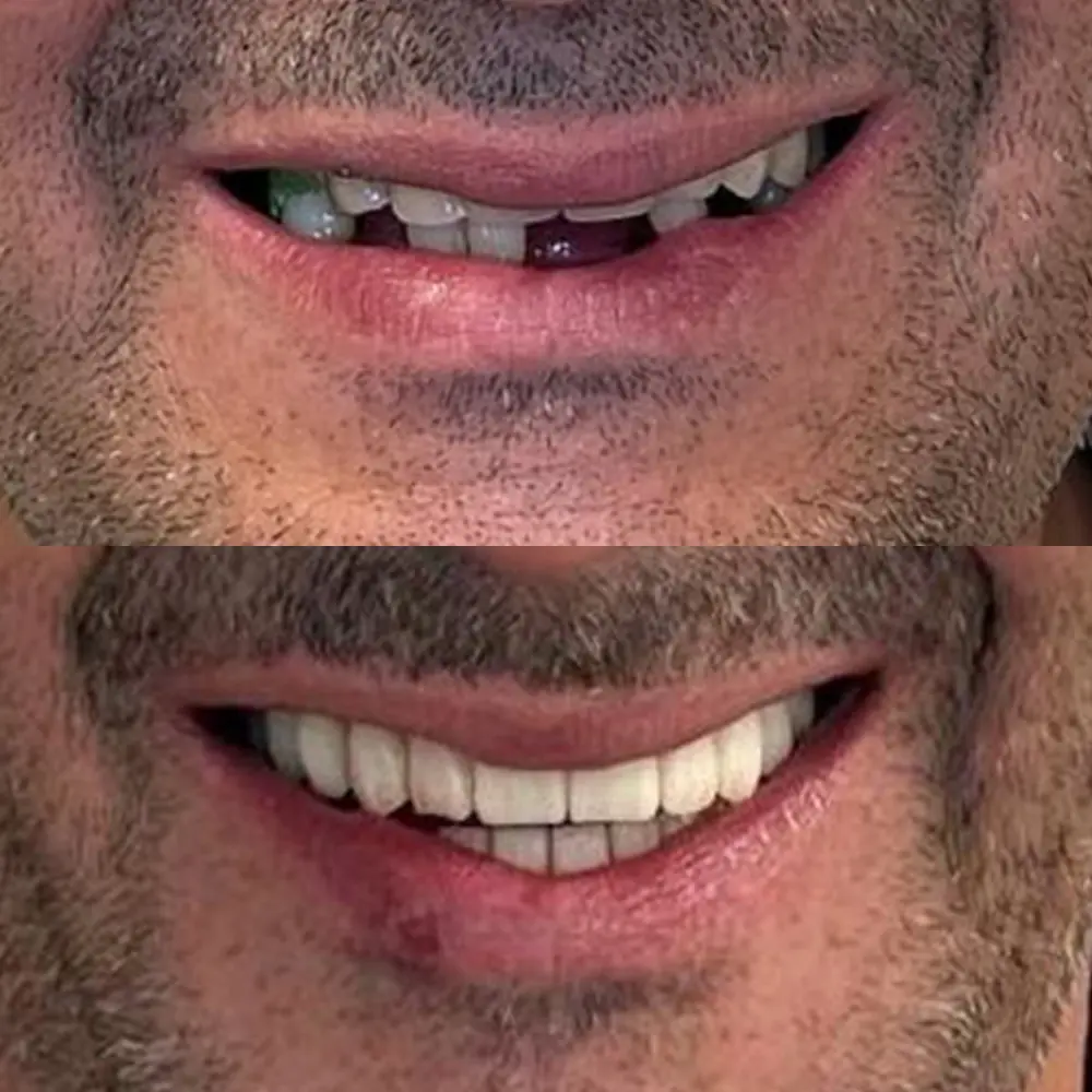 Caso real de implantes dentales en El Escorial