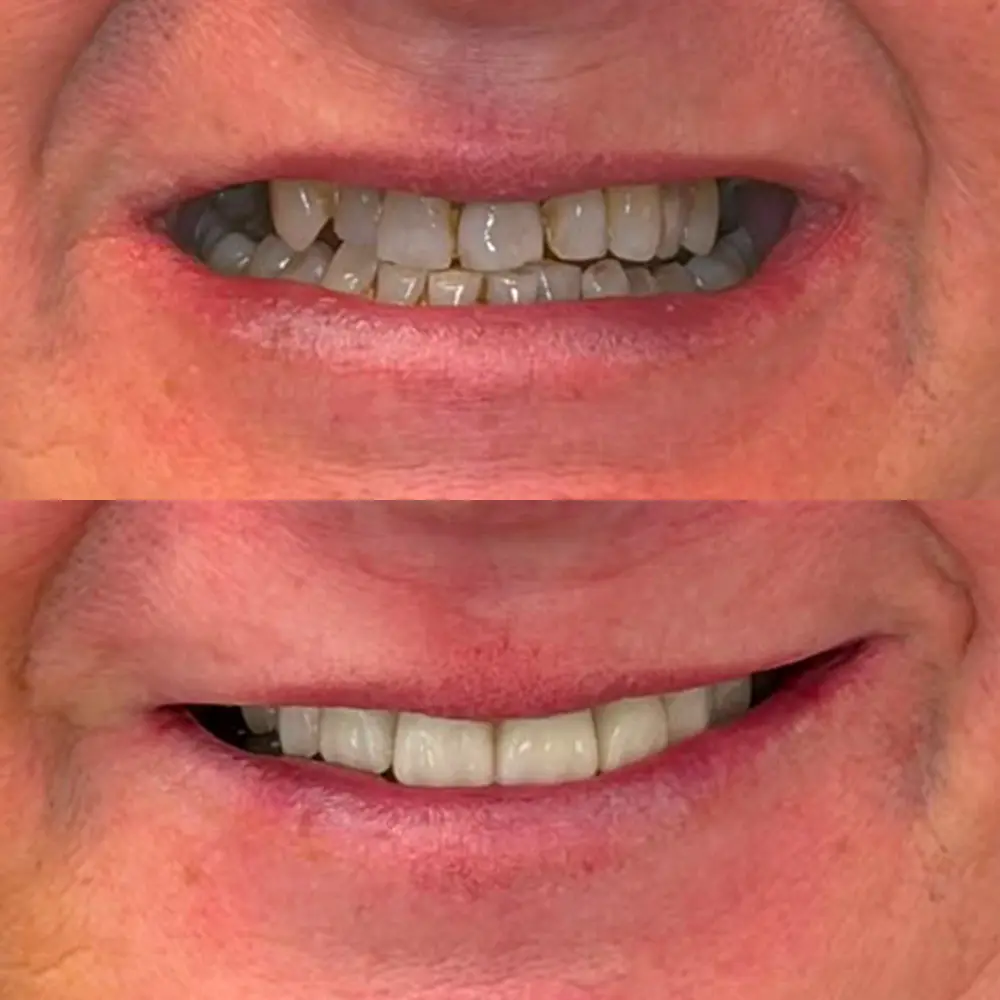 Caso real de implantes dentales en Majadahonda