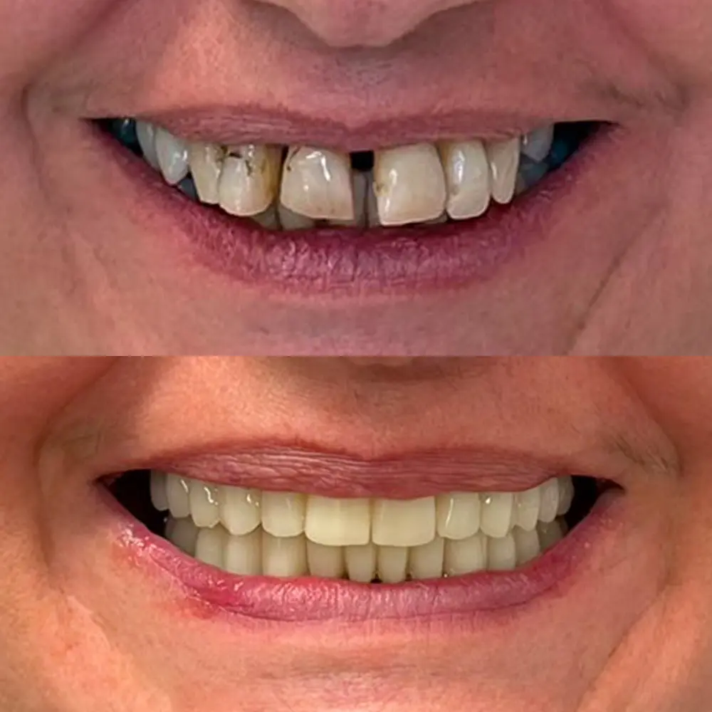 Antes y después de tratamiento con implantes dentales